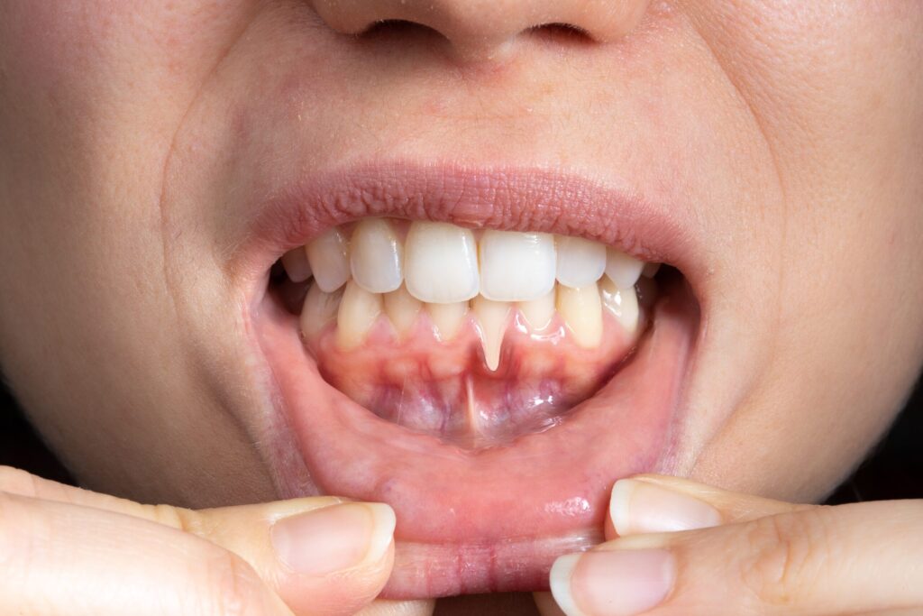 Preparing for teeth whitening with receding gums Beaconsfield